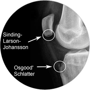 Sinding Larsen Johansson Disease Captions Funny
